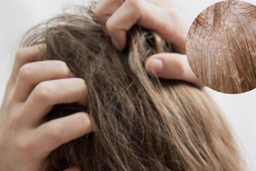 ISPOVEST O UŽASU ŽIVOTA SA  SEBOREJOM: "Do juče najefikasniji preparat postaje vaš smrtni neprijatelj!"