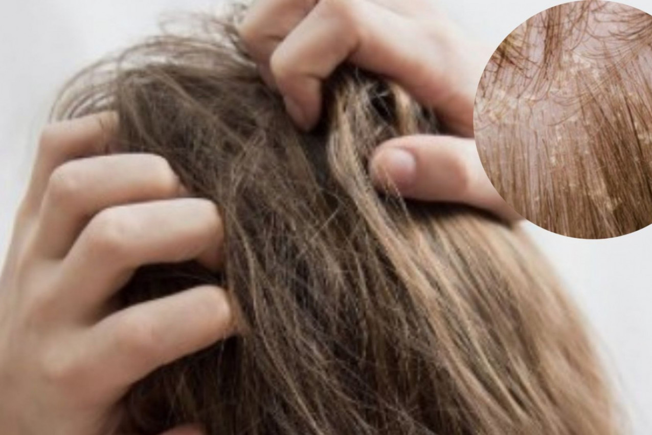 ISPOVEST O UŽASU ŽIVOTA SA  SEBOREJOM: "Do juče najefikasniji preparat postaje vaš smrtni neprijatelj!"