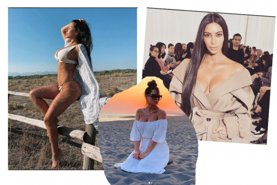 70 STRUČNJAKA, A NEMA LEKA:  Miss Dajana ima isti problem sa kožom kao Kim Kardašijan