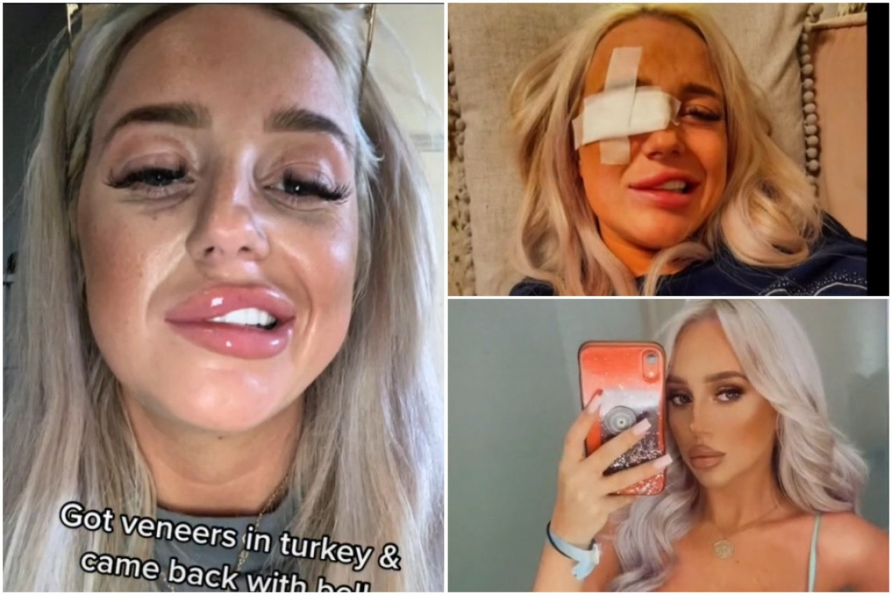 ZADESILA JE ISTA SUDBINA KAO ANĐELINU DŽOLI: Tiktokerka otišla u Tursku po savršen osmeh, vratila se sa paralisanim licem