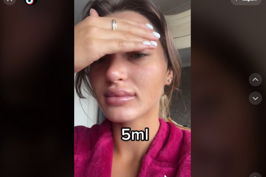 PROBLEME SA SAMOPOUZDANJEM “LEČI” FILERIMA: Zavisna od estetskih korekcija od 16. godine