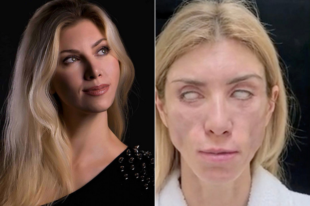 ZBOG PLASTIČNIH OPERACIJA VIŠE NE KONTROLIŠEM OČI! Nekada lepotica sada je unakažena: NE MOGU NI DA SE SMEJEM! (VIDEO)