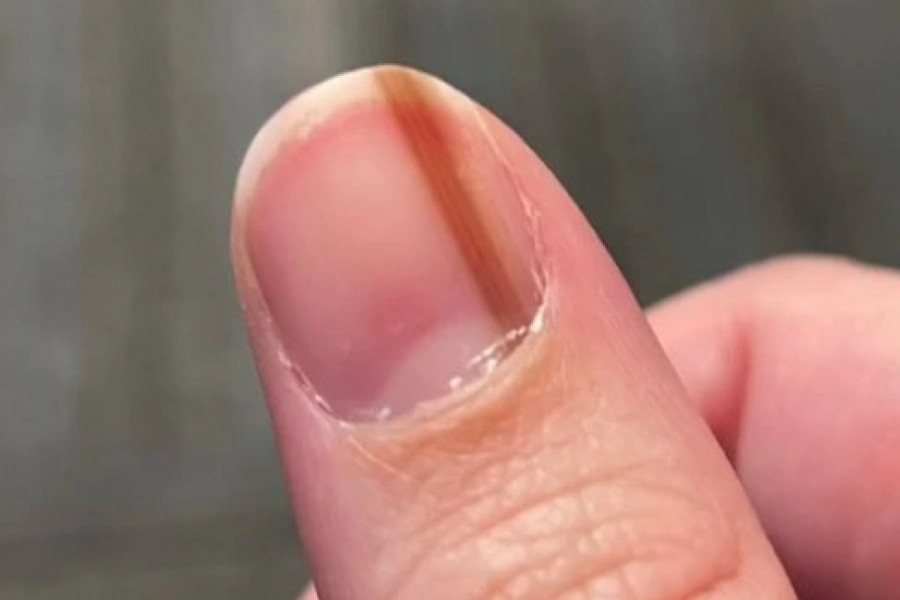 MISLILA SAM DA JE BELEG NA NOKTU SUPER, DOK NISAM OTKRILA ŠTA JE! Istina me je potpuno porazila!