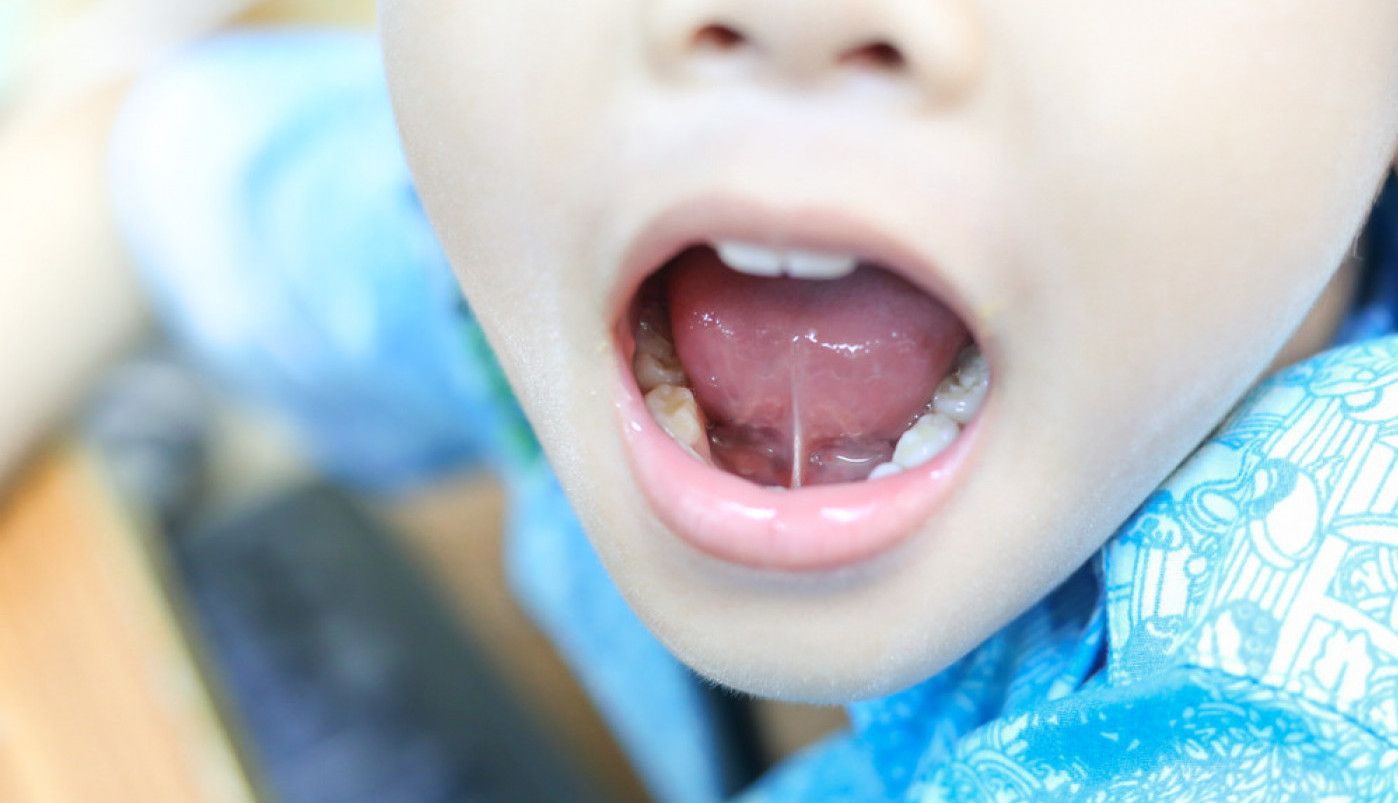 DEČAKU SLATKIŠ PROBUŠIO JEZIK, ZAVRŠIO U HITNOJ! Jezivo upozorenje očajne majke podiglo je svet na noge! (FOTO)