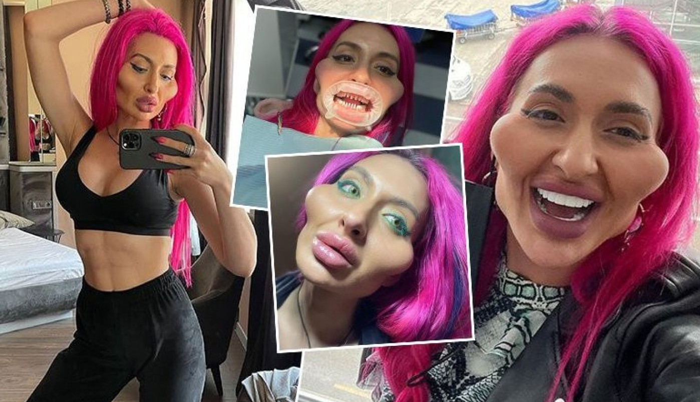 NOVA TRANSFORMACIJA! Sećate li se žene s najvećim jagodicama na svetu, pogledajte kako SADA IZGLEDA?!