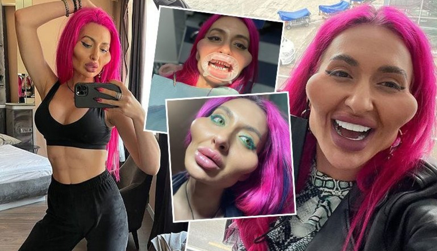 NOVA TRANSFORMACIJA! Sećate li se žene s najvećim jagodicama na svetu, pogledajte kako SADA IZGLEDA?!