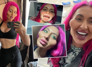 NOVA TRANSFORMACIJA! Sećate li se žene s najvećim jagodicama na svetu, pogledajte kako SADA IZGLEDA?!