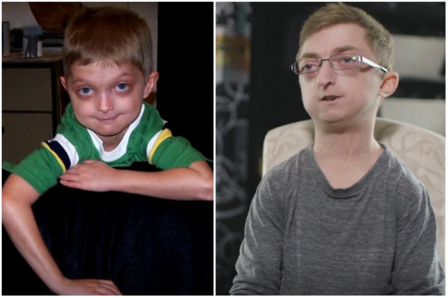 DANAS DEČAK, SUTRA DEDA! Jedini na svetu ima ovu bolest: Stari pet puta brže od bilo koga! (VIDEO)