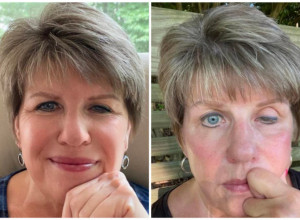 ŽELELA SAM DA ZATEGNEM ČELO, a umalo nisam ostala slepa! Priča ove žene izaziva jezu, išla je na tretman koji je u Srbiji IZUZETNO ZASTUPLJEN!