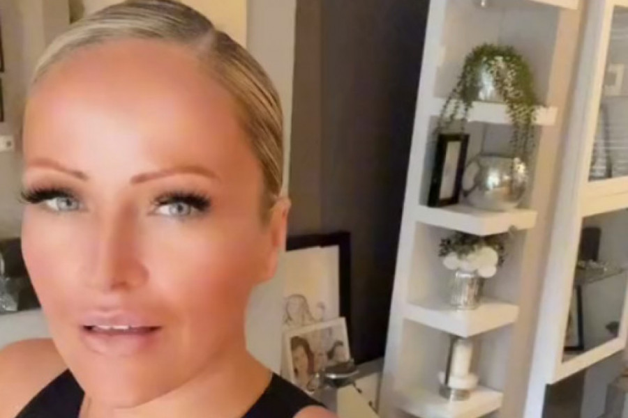 NIJE KORISTILA KREMU ZA SUNČANJE, A SADA JE POKAZALA POSLEDICE! Kada joj vidite glavu šokiraćete se, a tek LICE (FOTO)