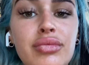 UNAKAŽENA SAM ZBOG SUNČANJA, do kraja života ću nositi masku! Potresne fotografije usana ove devojke obišle su svet, uradila je nešto što nikako nije smela!