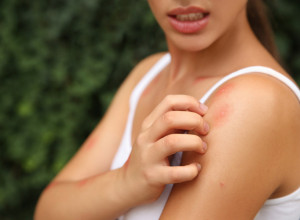 Jednostavan TRIK DA NAS VIŠE NE SVRBI: Spas od ujeda komaraca (VIDEO)