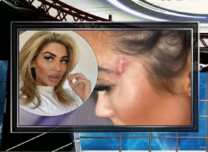 RIJALITI ZVEZDA OSAKAĆENA NA PLASTIČNOJ OPERACIJI: Dala sam 57.800 evra, a sada mi je život uništen! (FOTO, VIDEO)