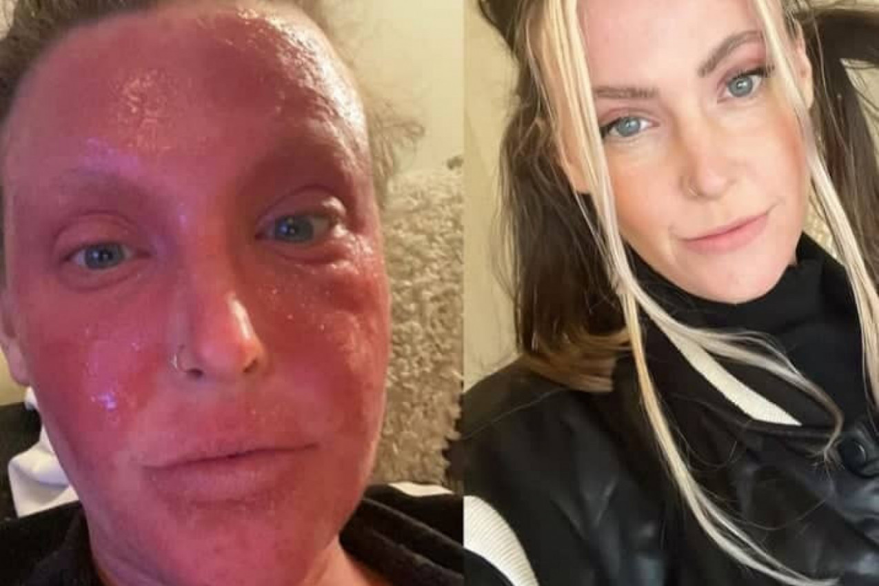 IZBEGAVALI SU JE NA ULICI ZBOG LICA! Ovoj ženi se život pretvorio u pakao nakon što je preko noći donela drastičnu odluku!