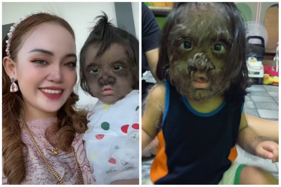 Medicinska sestra se onesvestila kada je videla rađanje ove bebe! U pitanju je jedan od milijardu slučajeva! (FOTO/VIDEO)