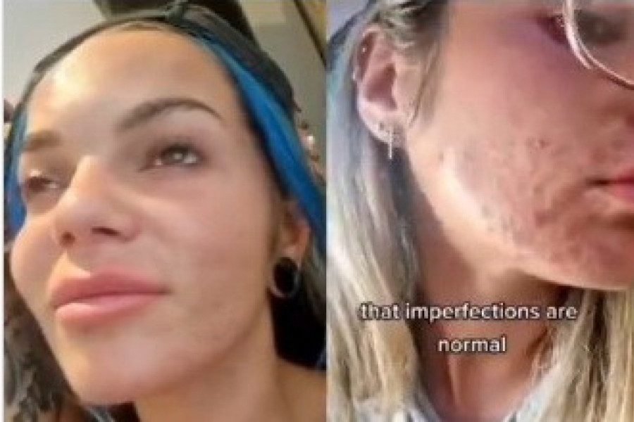 IZBACILA JEDNU NAMIRNICU IZ UPOTREBE I AKNE SU NESTALE! Evo kako je jedna žena sredila lice zbog kog se osećala kao čudovište! (FOTO)