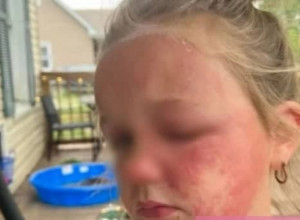 DEVOJČICA JE POMIRISALA CVET I USLEDIO JE PAKAO! U pitanju je biljka koja raste i u Srbiji, a očajna majka je apelovala na sve roditelje: Ona je još u teškom stanju!