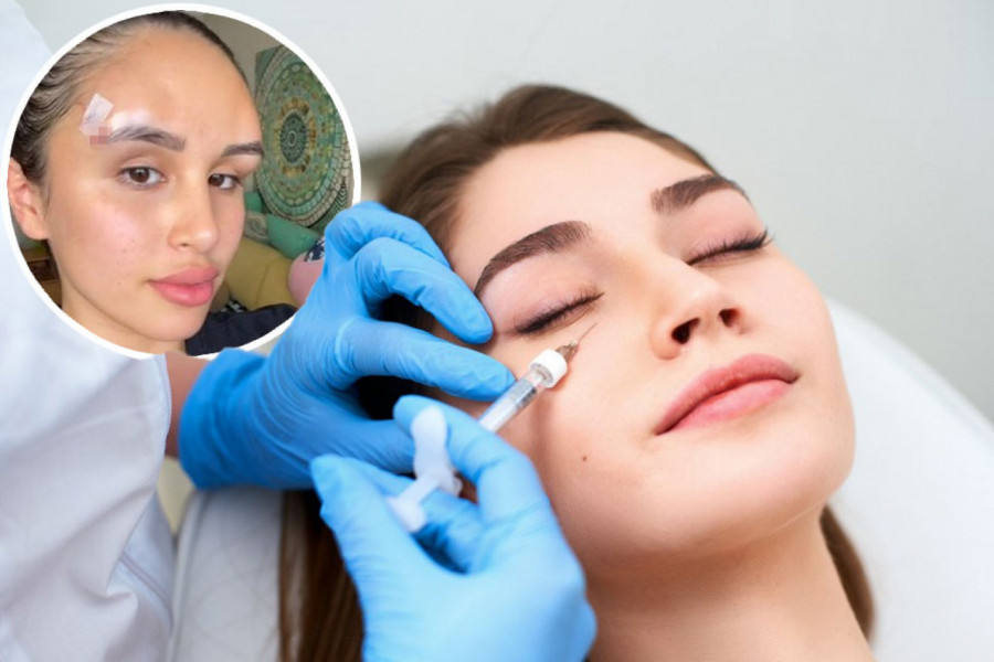 HTELA JE LISIČIJE OČI, A ONDA JE SVE POŠLO PO ZLU! Devojka pokazala kako joj je glava narasla zbog uvlačenja "žičica" pod kožu! (VIDEO)