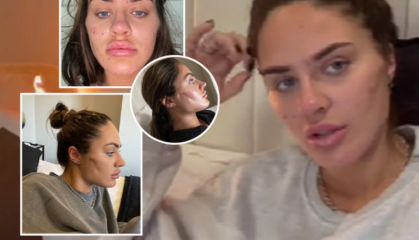 TIKTOKERKA UNAKAŽENA PLASTIČNOM OPERACIJOM: Podvrgla se intervenciji koja je popularna u Srbiji, a evo šta joj je ostalo od obraza! (VIDEO)