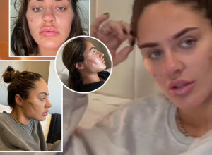 TIKTOKERKA UNAKAŽENA PLASTIČNOM OPERACIJOM: Podvrgla se intervenciji koja je popularna u Srbiji, a evo šta joj je ostalo od obraza! (VIDEO)