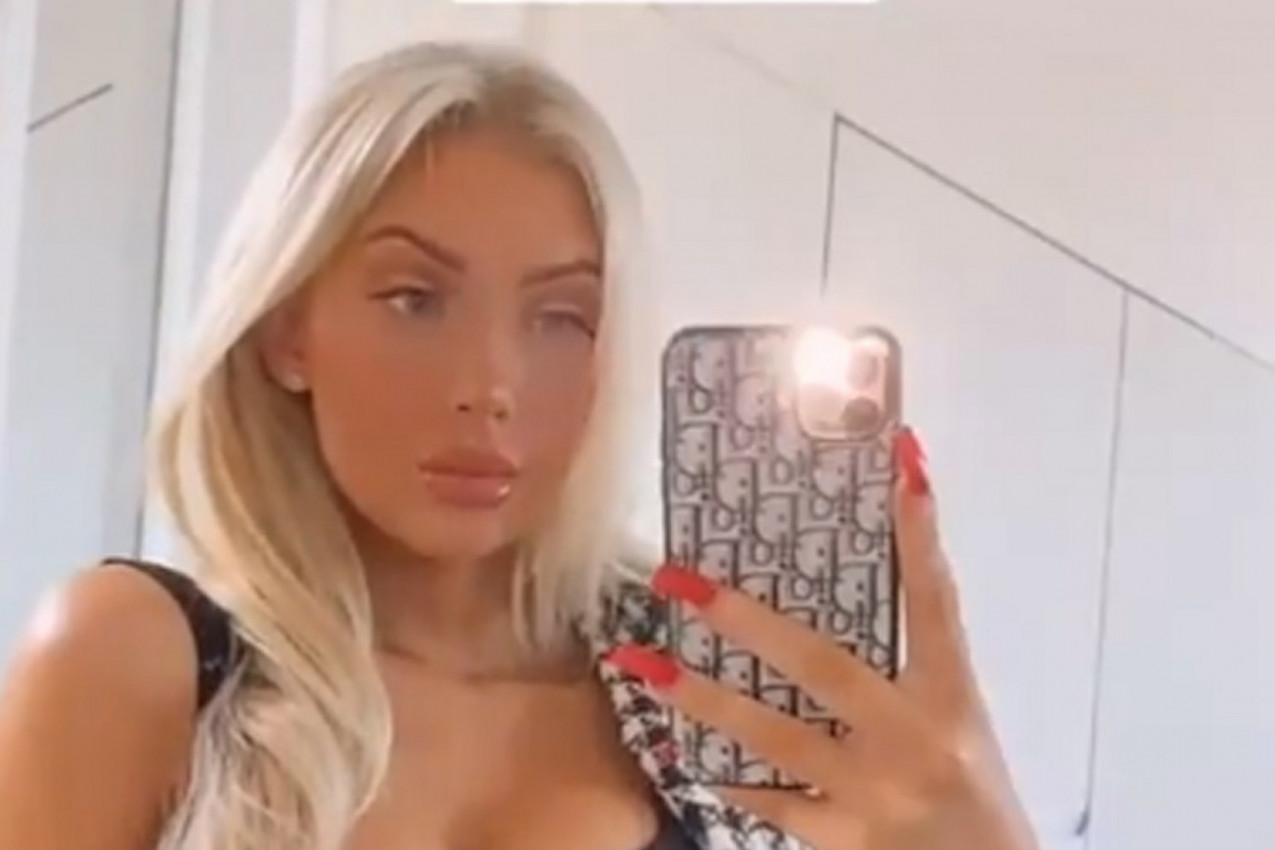 TO ŠTO SU MI UBRIZGALI U USNE JE POČELO DA SE POMERA U MENI: Ova očajna devojka je želela novi senzualni izgled, a doživela je pakao (FOTO, VIDEO)