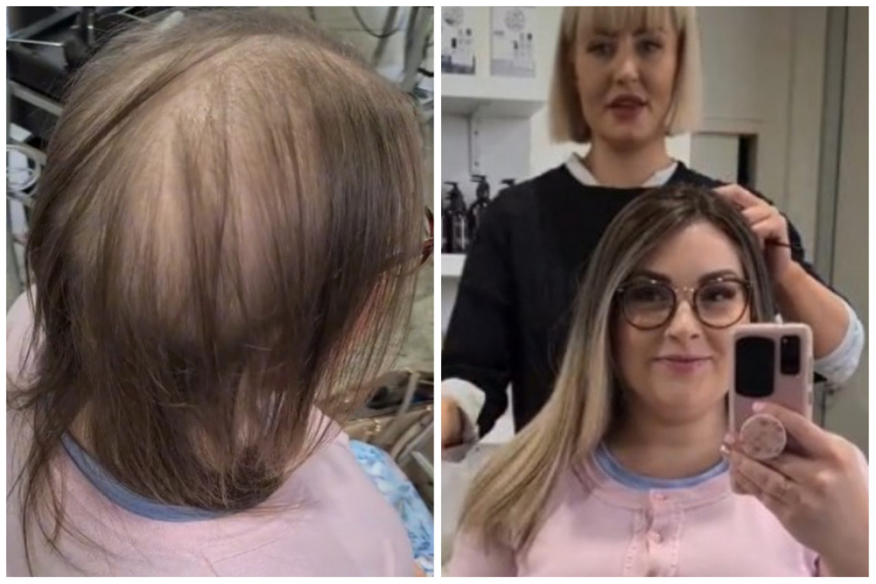 KOSA MI JE ISPADALA U PRAMENOVIMA OD 17. GODINE, usledio je pakao! Ispovest ove devojke dira u srce, utrljavala je čak i beli luk u teme, a onda je pronašla rešenje (VIDEO)