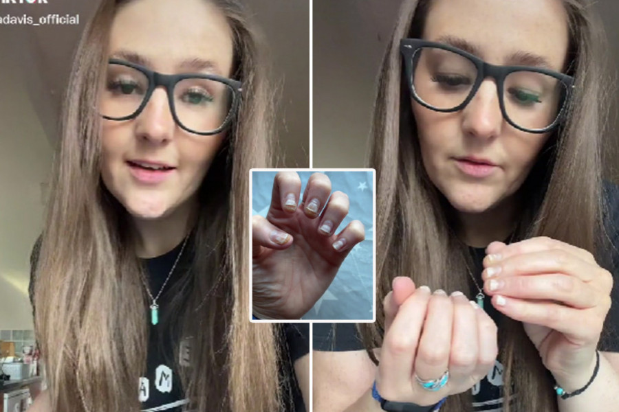 ZGROZIĆE VAS ONO ŠTO JOJ JE TRAJNI LAK URADIO S PRSTIMA! Očajna devojka preživela noćnu moru: Ljudi na ulici su me gledali kao da sam nakaza! (FOTO/VIDEO)