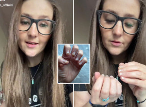 ZGROZIĆE VAS ONO ŠTO JOJ JE TRAJNI LAK URADIO S PRSTIMA! Očajna devojka preživela noćnu moru: Ljudi na ulici su me gledali kao da sam nakaza! (FOTO/VIDEO)