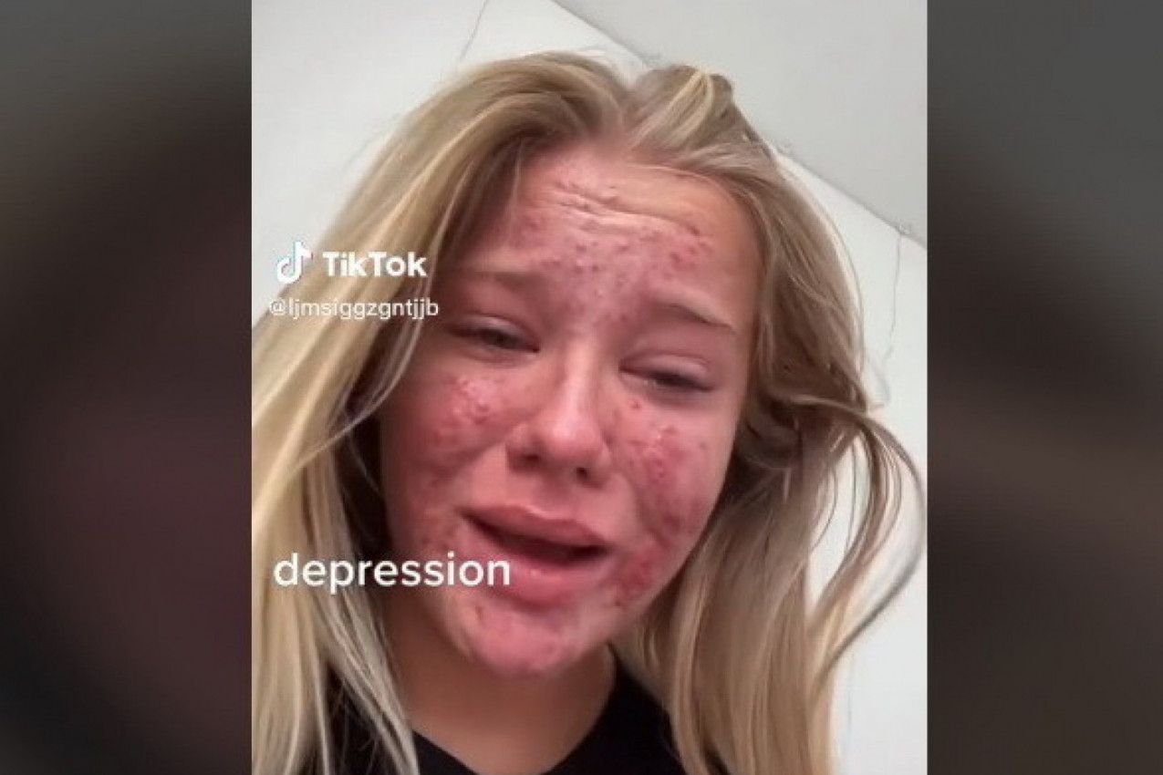 ZBOG LICA NIJE IZLAZILA NA ULICU I SVAKODNEVNO JE PLAKALA, a onda se dogodilo čudo! (VIDEO)