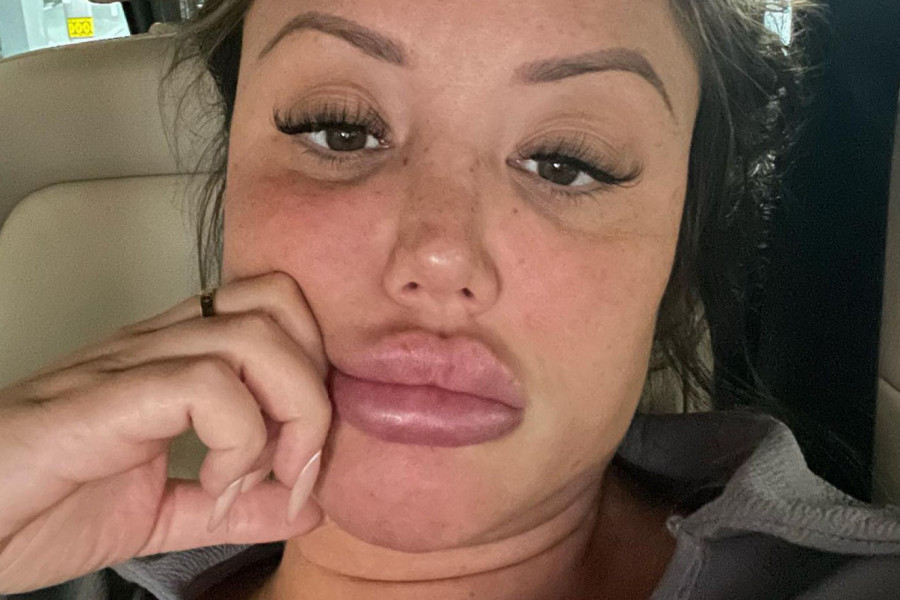 RIJALITI ZVEZDA UKLONILA OGROMAN IMPLANT IZ USANA: Zbog njih su je bukvalno vređali, a sada je neprepoznatljiva! (FOTO/VIDEO)