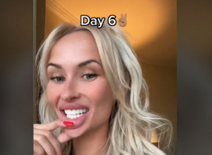 CURILA MI JE KRV IZ USTA I ZUBI SU MI LETELI NA SVE STRANE! Ovo vam niko neće reći o proceduri ugradnje turskih zuba, ali ja ću ispričati sve!