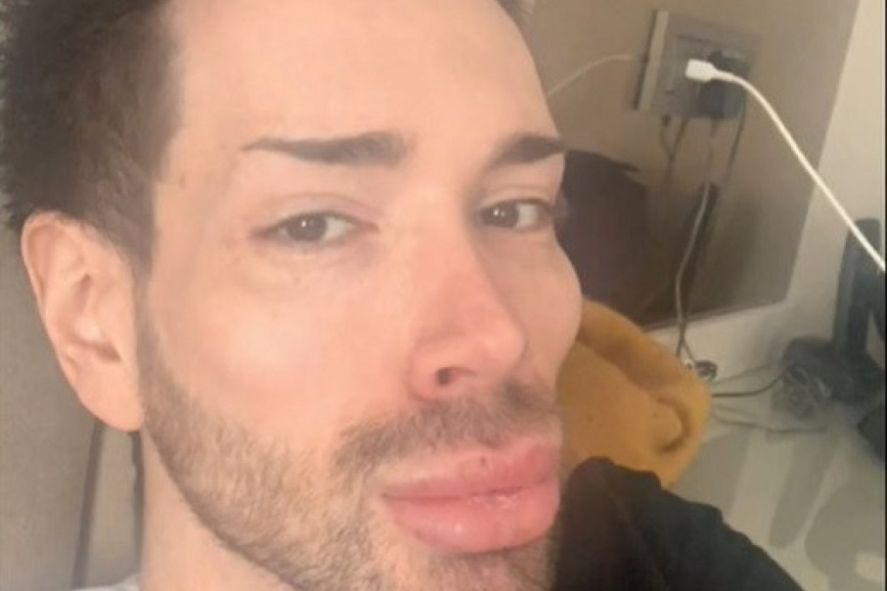 POTROŠIO JE BOGATSVO DA NAPUNI LICE FILERIMA, a sada ih je sve povadio: Više ne liči na sebe (FOTO)