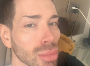 POTROŠIO JE BOGATSVO DA NAPUNI LICE FILERIMA, a sada ih je sve povadio: Više ne liči na sebe (FOTO)