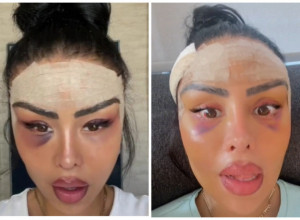 BILA JE PRELEPA, A ONDA JE U TURSKOJ ODRADILA OPERACIJU LISIČIJE OČI: Njene snimke sada komentariše na hiljade ljudi! (VIDEO)