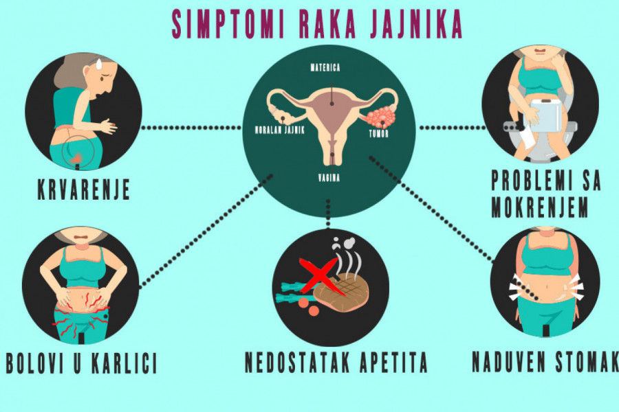 5 KRAJNJE NEOBIČNIH SIMPTOMA RAKA JAJNIKA: Ako ih primetite, odmah se obratite lekaru, jedan je posebno iznenađujuć i oseća se u leđima!