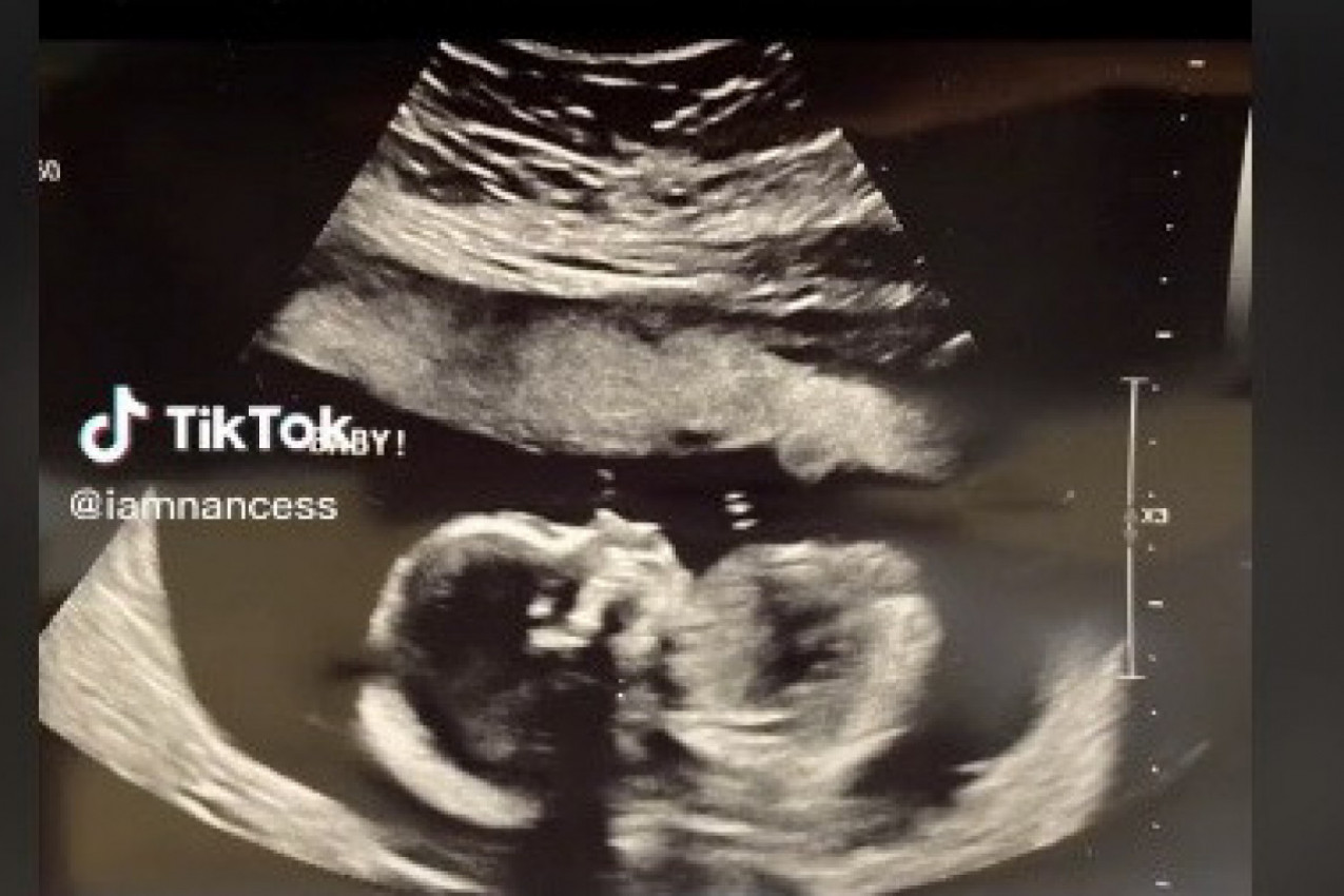 SVAKI PUT KADA SAM BILA NA ULTRAZVUKU GOVORILI SU MI: To dete će zaista da ima mnogo kose, a onda sam je rodila... (VIDEO)