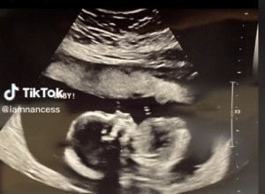 SVAKI PUT KADA SAM BILA NA ULTRAZVUKU GOVORILI SU MI: To dete će zaista da ima mnogo kose, a onda sam je rodila... (VIDEO)