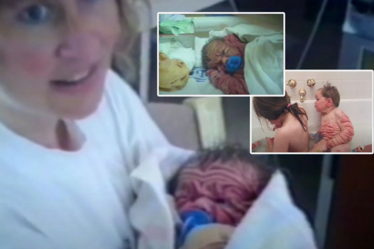 DA LI SE SEĆATE SMEŽURANE BEBE KOJA JE NA ROĐENJU PRESTRAVILA I RODITELJE I LEKARE? Imala je toliko kože da je jedva gledala, šok je tek usledio, a evo GDE JE ONA DANAS! (FOTO/VIDEO)
