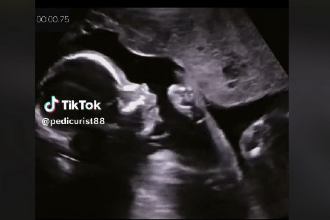 SNIMILI SU BEBU ULTRAZVUKOM, A ONDA ZANEMELI OD ŠOKA! I lekari u čudu: Da li je moguće da to radi dete od samo 15 nedelja?! (VIDEO)