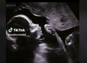 SNIMILI SU BEBU ULTRAZVUKOM, A ONDA ZANEMELI OD ŠOKA! I lekari u čudu: Da li je moguće da to radi dete od samo 15 nedelja?! (VIDEO)