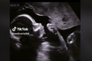 SNIMILI SU BEBU ULTRAZVUKOM, A ONDA ZANEMELI OD ŠOKA! I lekari u čudu: Da li je moguće da to radi dete od samo 15 nedelja?! (VIDEO)