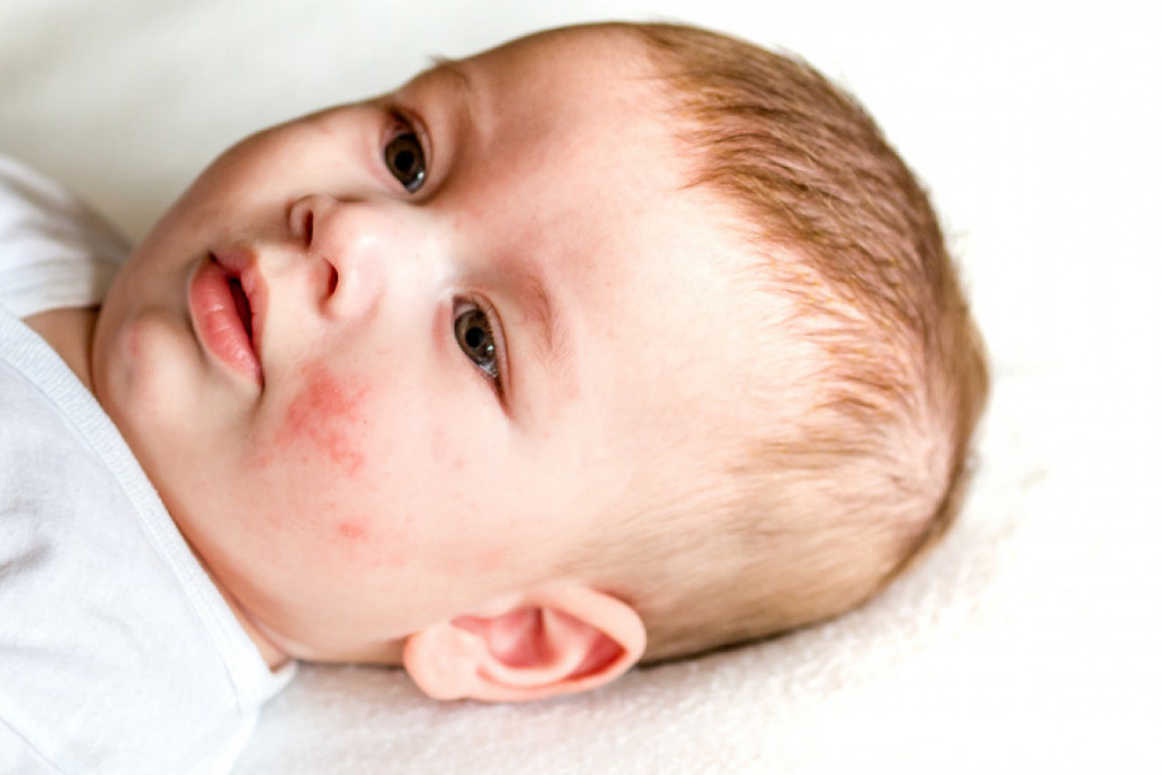 EKCEM KOD BEBA JE MNOGO ČEŠĆI NEGO ŠTO SE MISLI: Simptomi su vrlo neprijatni, a ovo su ključne razlike u odnosu na psorijazu (FOTO)