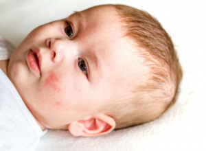 EKCEM KOD BEBA JE MNOGO ČEŠĆI NEGO ŠTO SE MISLI: Simptomi su vrlo neprijatni, a ovo su ključne razlike u odnosu na psorijazu (FOTO)