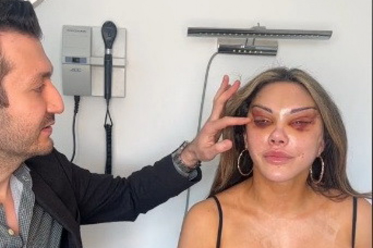 ŽELELA JE MAČJE OČI A ONDA JE SVE KRENULO PO ZLU: Dobila je uske proreze kroz koje jedva vidi, a kakvo je tek objašnjenje njenog estetskog hirurga (VIDEO)