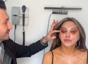 ŽELELA JE MAČJE OČI A ONDA JE SVE KRENULO PO ZLU: Dobila je uske proreze kroz koje jedva vidi, a kakvo je tek objašnjenje njenog estetskog hirurga (VIDEO)