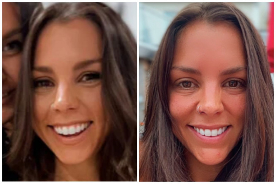 OTIŠLA JE NA ULEPŠAVANJE, ALI JE SVE KRENULO PO ZLU: "Izgledala sam kao psihopata punih 5 meseci sa zaleđenim plastičnim osmehom na licu!" (VIDEO)