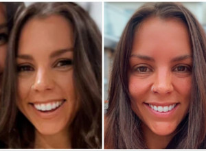 OTIŠLA JE NA ULEPŠAVANJE, ALI JE SVE KRENULO PO ZLU: "Izgledala sam kao psihopata punih 5 meseci sa zaleđenim plastičnim osmehom na licu!" (VIDEO)