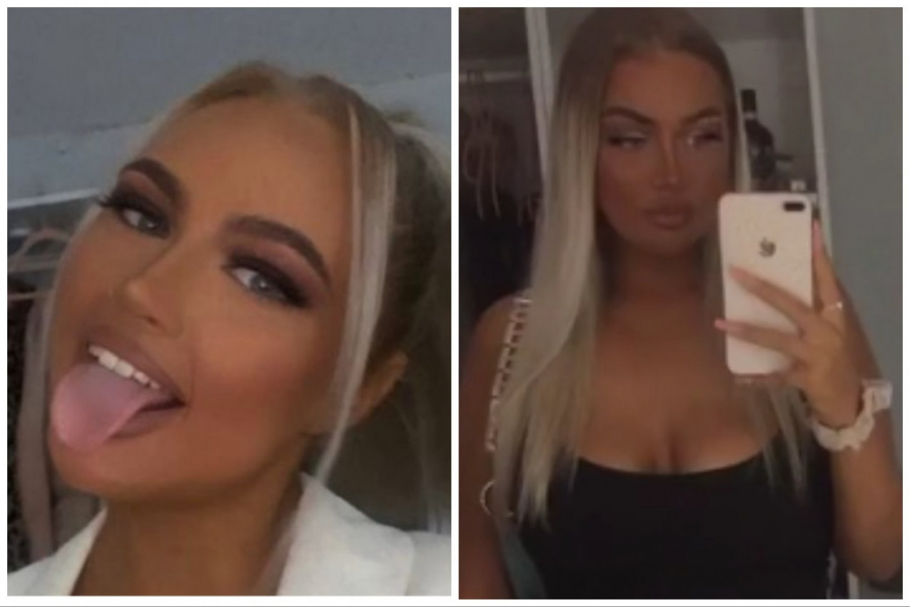 LEPOTICA JE POŽELELA SENZUALNIJI IZGLED, A SAD SE GORKO KAJE: "Kao da imam ogroman, vreo krompir umesto usana koji će svakog trenutka da eksplodira!"(FOTO+VIDEO)