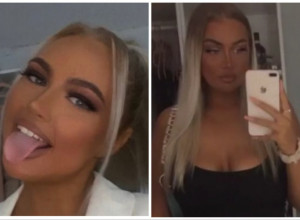 LEPOTICA JE POŽELELA SENZUALNIJI IZGLED, A SAD SE GORKO KAJE: "Kao da imam ogroman, vreo krompir umesto usana koji će svakog trenutka da eksplodira!"(FOTO+VIDEO)