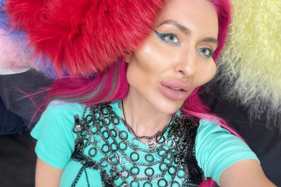 ŽENA SA NAJVEĆIM JAGODICAMA NA SVETU: Anastasija je pokazala kako je izgledala pre operacija i ostavila javnost u neverici (FOTO)